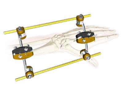 EXFIX MRI EXTERNAL FIXATION SYSTEMS