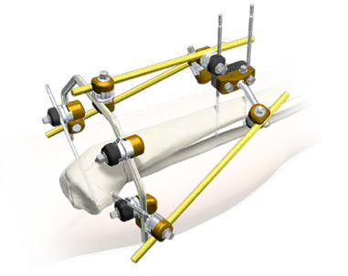 EXFIX MRI EXTERNAL FIXATION SYSTEMS