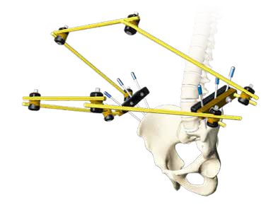 EXFIX MRI EXTERNAL FIXATION SYSTEMS