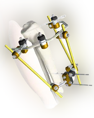 EXFIX MRI EXTERNAL FIXATION SYSTEMS